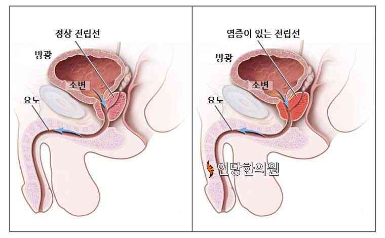 전립선염