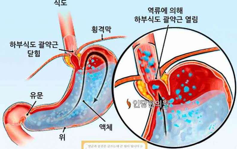 역류성식도염, 알아봅시다. 1) 정의와 증상